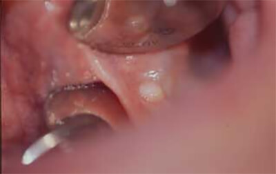 Fig.4 lesión quística de color amarillento en cara ventral de lengua