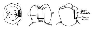 Figura N° 1 Vista oclusal, proximal y corte sagital del receptáculo (componente hembra) del aditamento de Thompson