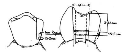 Figura N° 3 Medidas mìnimas del receso divergente, pozo y repisa del receptáculo hembra del aditamento de Tompson.