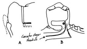 Figura N° 4 a.- Socavado retentivo lingual a mismo nivel de la repisa. b.- Brazo lingual colado con conector mayor hendido.