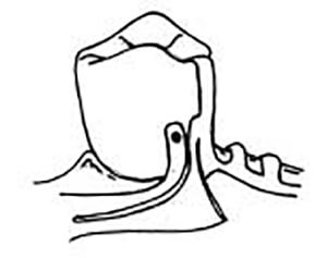 Figura N°5 Diseño de Van Dam con brazo lingual colado