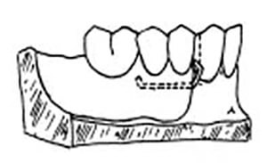 Figura N°6 Diseño de Smith, brazo de retención de oro.
