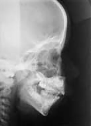 Imagen radiográfica representativa de una deficiencia mandibular