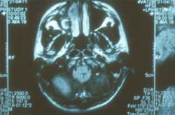 Figura 9. Resonancia Magnética cerebral
