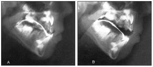 Fig. 1: Respiración Buco-nasal. A. Oclusión Habitual. B. Posición de Reposo Tomado de Rakosi. 1992.