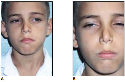 Fig. 5:. A: Flácidez en una narina. B: Flácidez en ambas narinas.