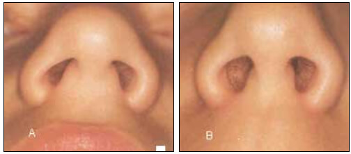 Fig. 6:Tamaño y Forma de Narina. A: Narinas diferentes. B: Narinas iguales. Tomado de Rakosi.1992.