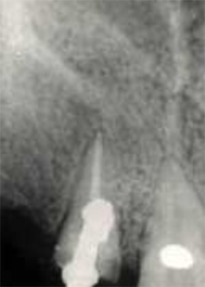 Figura 2: Postoperatorio falsa vía obturada con amalgama y defecto óseo relleno con Hidroxiapatita porosa.