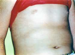 Figura 2 – La hiperpigmentación cutánea de la espalda.