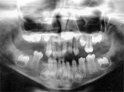 Figura 5 - La radiografía panorámica reveló la ausencia de los gérmenes de los cuatro segundos premolares y primeros premolares inferiores.