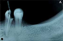 Fig. 2A - Radiografìa ante-mortem demostrando la prueba del cono para obturación endodóntica.
