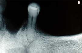 Fig. 2B - Radiografìa post-mortem para confronto odonto-legal.