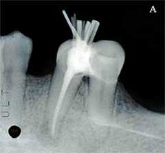 Fig. 3A - Radiografía ante-mortem demostrando la obturación endodóntica final.