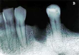 Fig. 3B - Radiografía post-mortem para confronto odonto-legal.