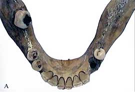 Fig. 5A - Vista olcusal de la mandíbula.