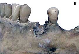 Fig. 5B. Región vestibular inferior izquierda.