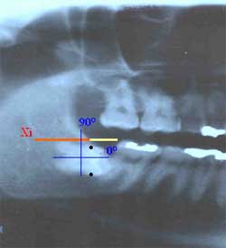 DIAGRAMA 1 Variables medidas en la radiografía, en Negro ancho mesiodistal del tercer molar, Amarillo distancia borde anterior rama ascendente cara distal de 2° molar, Verde distancia punto Xi a cara distal de 2° molar, Azul angulacion del tercer molar.