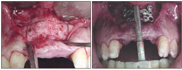 Fig. 4
Confección de las osteotomías verticales y horizontales para la obtención del disco de transporte. B- Posicionamiento y fijación del distractor