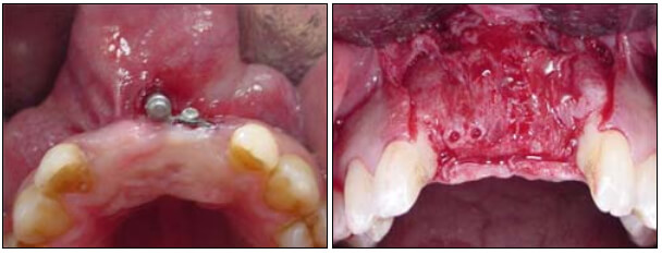 Fig. 7 CImágenes clínicas a las 10 semanas posteriores durante el segundo tiempo quirúrgico para la remoción del distractor y la colocación de los implantes, donde se evidencia la ganancia no solo en altura y volumen óseo sino también de tejidos blandos