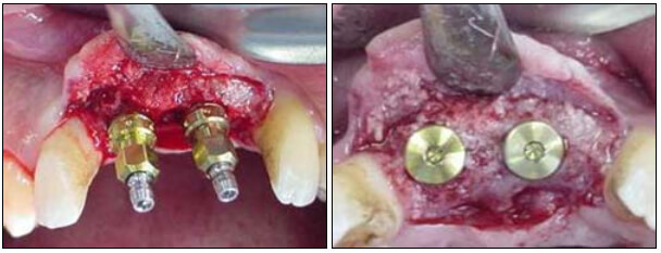 Fig. 8 Colocación de los implantes