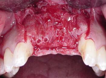 Fig. 9 Imagen clínica donde se aprecia la ganancia en tejido óseo en el reborde alveolar