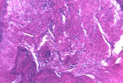 Figura 4. Periodontitis de 21 días de evolución, nótese la reabsorción de la cresta ósea interradicular. H&E 10x