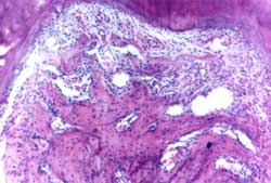 Figura 6. Caso perteneciente al grupo irrigado con 0,5 ml de metronidazol. Nótese la reducción del cuadro inflamatorio y de la pérdida ósea.