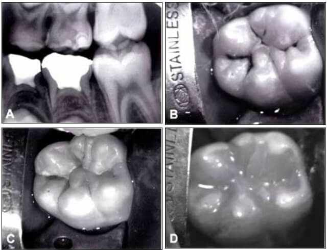 Figura 1: Utilización del aparato de aire abrasivo en el diente 46 con lesión de caries (A, B); aspecto de la cavidad después de la preparación (C), restauración final (D).