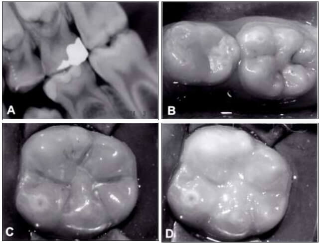 Figura 2: Utilización del Sistema CVDentus® con la punta cónica, en el diente 36 con lesión de caries (A, B); aspecto de la cavidad después de la preparación (C), restauración final (D).
