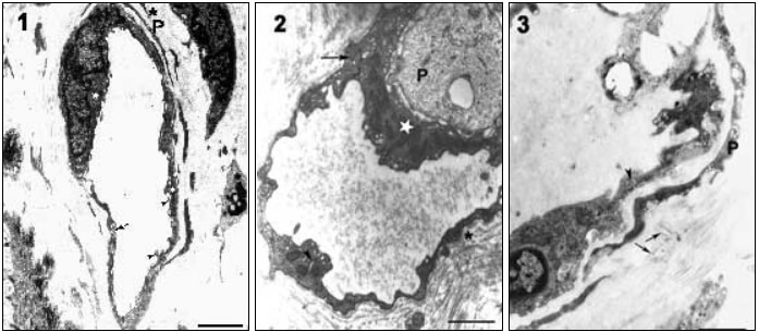 Fig. 1. En esta micrografía electrónica correspondiente a una sección de displasia leve se observa: Aparato de Golgi (estrella), Vesículas pinocíticas (flecha), prolongaciones endoteliales (cabezas de flechas) y pericito (P). Bar=0,5 m. Fig.2. Sección correspondiente a una lesión con displasia moderada, en la que se observan uniones interendoteliales (flecha), retículo endoplasmático rugoso (cabeza de flecha), mitocondrias (estrella), membrana basal (asterisco) y pericito (P). Bar=0,5 m. Fig. 3. Micrografía electrónica de una lesión con displasia moderada en la que se muestra: colágeno (flecha), cuerpo multivesicular (cabeza de flecha) y pericito (P). Nótese la abundancia de vesículas pinocíticas y cavéolas. Bar=0,5 m.