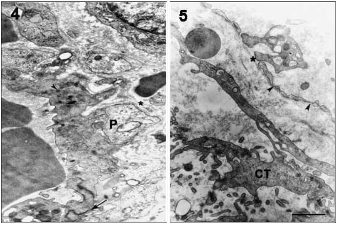 Fig.4. Micrografía electrónica de una sección de carcinoma espinocelular, que muestra: uniones interendoteliales (flecha), cuerpos densos (cabeza de flecha) y pericito (P). Bar=0,5µm. Fig. 5. En esta micrografía electrónica de una sección de carcinoma espinocelular se observa: célula tumoral (CT), fenestraciones (cabezas de flecha), y membrana basal (asterisco). Bar=0,5µm