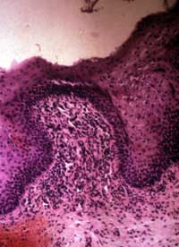 Foto 4: Carcinoma de células escamosas