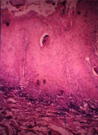 Foto 5: Carcinoma Verrugoso de Ackerman
