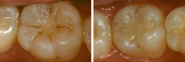 Figuras 3 y 4 Fotografías de las restauraciones definidas con criterio Bravo, para pigmentación cavo superficial según criterios del método USPHS, después de 2 años
