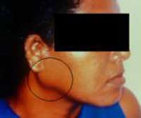 Fig.1. Masa tumoral bien circunscrita en región infraauricular derecha.