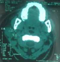 Fig.3. Lesión ocupante de espacio en región parotídea derecha.