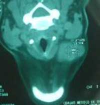 Fig.4. Lesión ocupante de espacio en región submandibular izquierda.