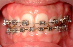 Figura 1 Agrandamiento gingival y dientes con coronaria clínica corta más acentuada en los dientes antero superiores