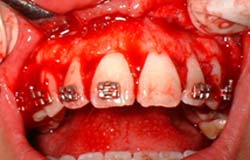 Figura 3 Fase Quirúrgica: gingivectomia y osteoplastia del maxilar superior, vista de frente