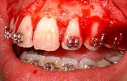 Figura 4 Fase Quirúrgica: gingivectomia y osteoplastia del maxilar superior, vista lateral izquierda