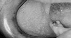 Fig 2. GF en mucosa del fondo del vestíbulo derecho (12/06/04)