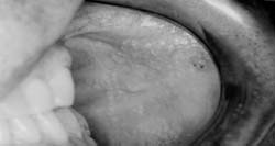 Fig. 3 GF en mucosa del carrillo izquierdo (12/06/04)