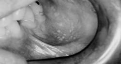 Fig. 4 GF en mucosa del fondo del vestíbulo izquierdo (12/06/04)