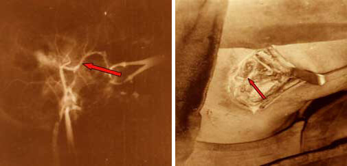 Disección de las carótidas primitivas y externa / Arteriografía carotídea externa. Fase de llene arterial