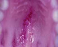 Fig 5. Lesión macular eritematosa
