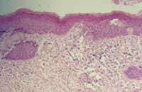 Fig 8. Infiltrado inflam. prof.