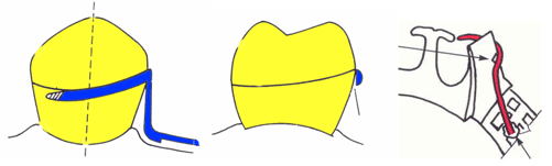 Fig. 2 Retenedor RPA, el brazo retentivo debe ser construido de forma tal que solo el borde oclusal haga contacto con el mayor contorno del diente en disto vestibular, otra alternativa es reemplazarlo por un elemento forjado