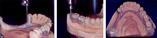 Fig. 4 Preparación de bloqueo distal del 34 donde se colocará una placa proximal; preparación de lechos en los molares para un retenedor de pase, observe la relación del lecho con la línea de máximo contorno y la calibración; preparación de alivio en la brecha edéntula su extensión y ubicación corresponde a la zona donde se ubicara la rejilla metálica de la base combinada