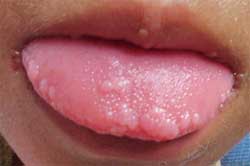 Fig. 1 y 2 Lesiones de HEM en mucosa lingual y labial