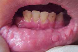 Fig. 1 y 2 Lesiones de HEM en mucosa lingual y labial
